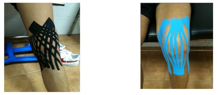 Аппликация кинезиотейпов при разрыве передней крестообразной связки Аппликация кинезиотейпов при разрыве передней крестообразной связки