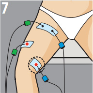 Электростимуляция при разрыве четырехглавой Электростимуляция при разрыве четырехглавой