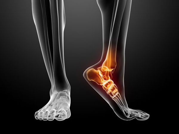 Электростимуляция Compex при подошвенном фасциите