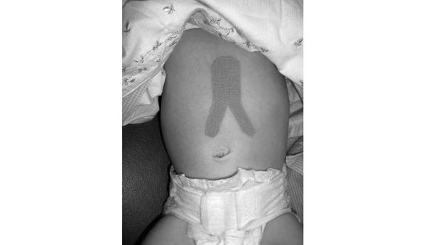 Кинезиотейпирование и массаж при желудочно-пищеводном рефлюксе у младенца