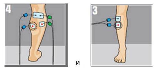 Электростимуляция Compex Mi Sport после перелома большеберцовой кости